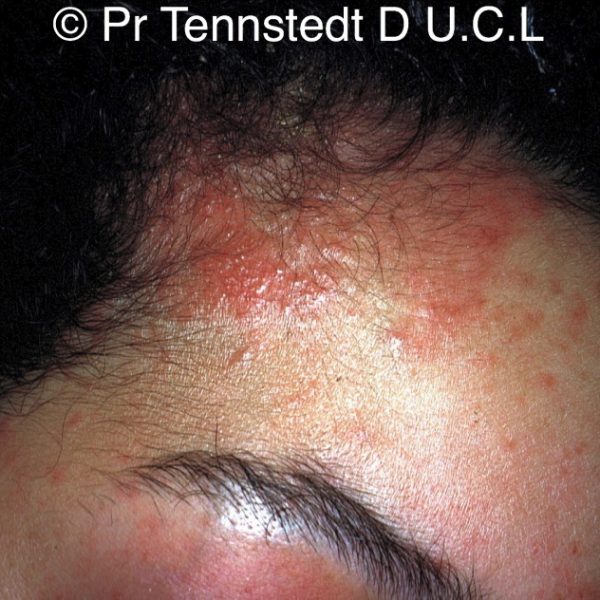 Allergie aux teintures pour cheveux quels symptômes