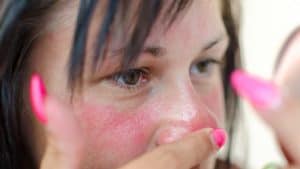 femme-allergie-peau Manifestation des allergies chimiques