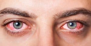 allergie-yeux-rouge