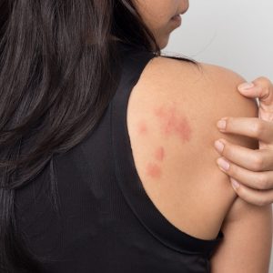 eczema-allergie