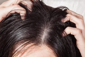 Cheveux-pellicules-1