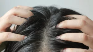 Une femme se gratte le cuir chevelu