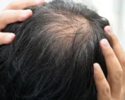 coloration pour homme et calvitie : quel lien ?