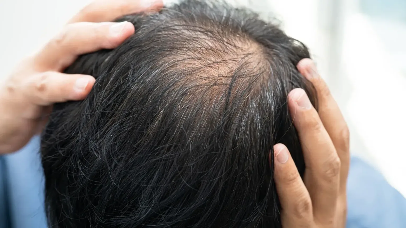 coloration pour homme et calvitie : quel lien ?