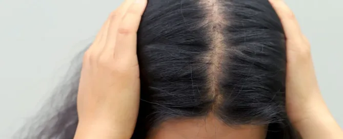 Cheveux et stress : chute de cehevux