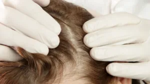 diagnostic du cuir chevelu apr un professionel