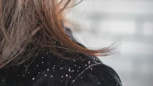 femme de profil avec pellicule sur sa veste