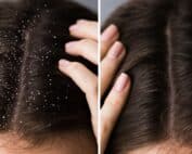 Pellicules sur cheveux avant après