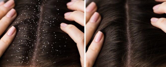 Pellicules sur cheveux avant après