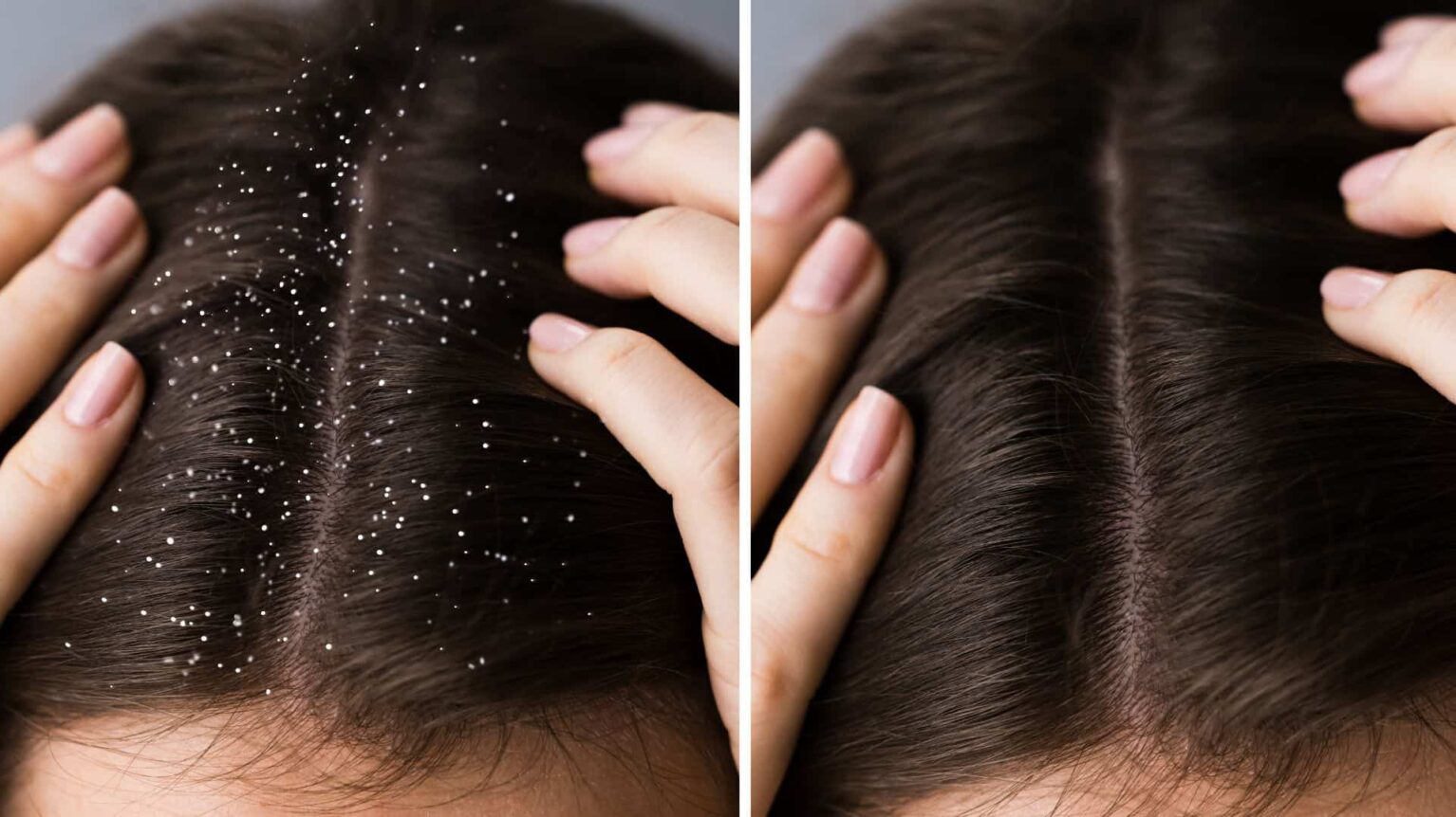 Pellicules sur cheveux avant après